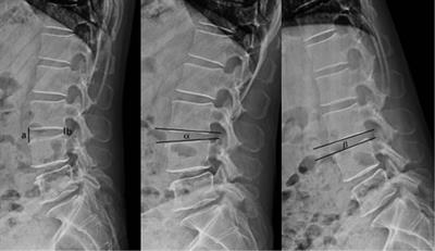 Clinical efficacy of transforaminal endoscopic lumbar discectomy for lumbar degenerative diseases: A minimum 6-year follow-up